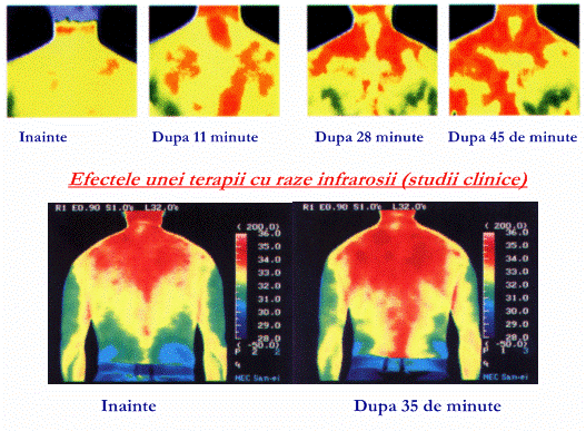 efectele unei terapii cu raze infrarosii