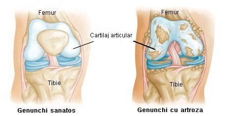 artroza simptomelor articulației genunchiului și