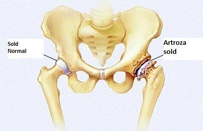 cauze ale artrozei coxartrozei articulației șoldului