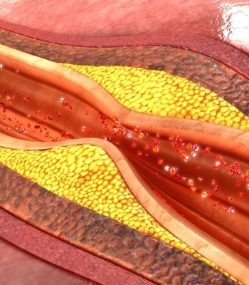 arteroscleroza